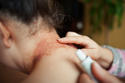 Parent applying topical medication to their child's eczema